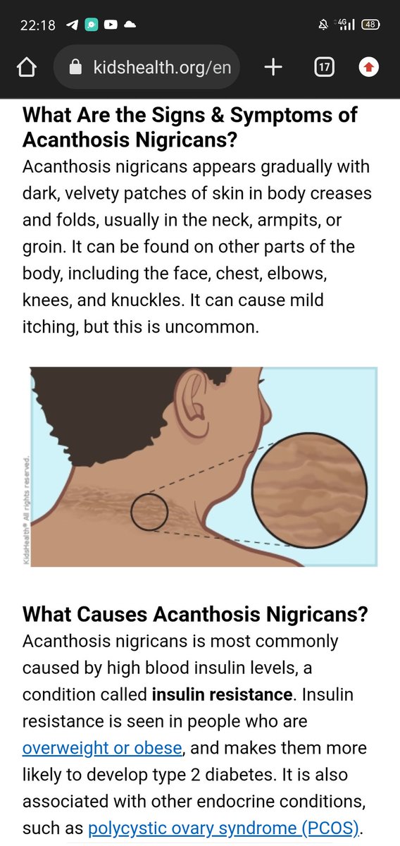 DebiMartinn's tweet photo. @ohmybeautybank Bahasa medisnya, ini Acanthosis Nigricans. Biasa muncul pada daerah lipatan paha, lipatan leher, lipatan ketiak. Sering ditemukan pada orang dengan kadar insulin tinggi dalam darah, akibat tingginya gula di dalam darah. Solusi : gaya hidup sehat, defisit kalori harian. https://t.co/SlOKOkpoHN