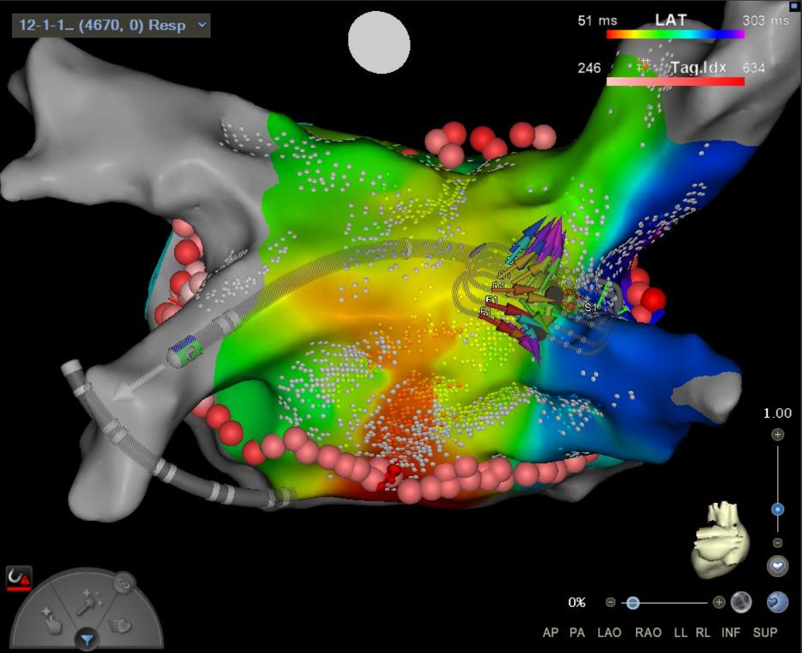 ReddyEPS's tweet photo. Another nice case with OPTRELL!
Re-do Afib with reconnection of 3/4 PVs. Did a SIngle Ring Lesion. Optrell display of vectors with different sizes (speed), direction and color (local timing) were very helpful. @BiosenseWebster @josoriomd @jskoruth @gautamsand @SethHSheldon https://t.co/Wh8Fo1NR8X