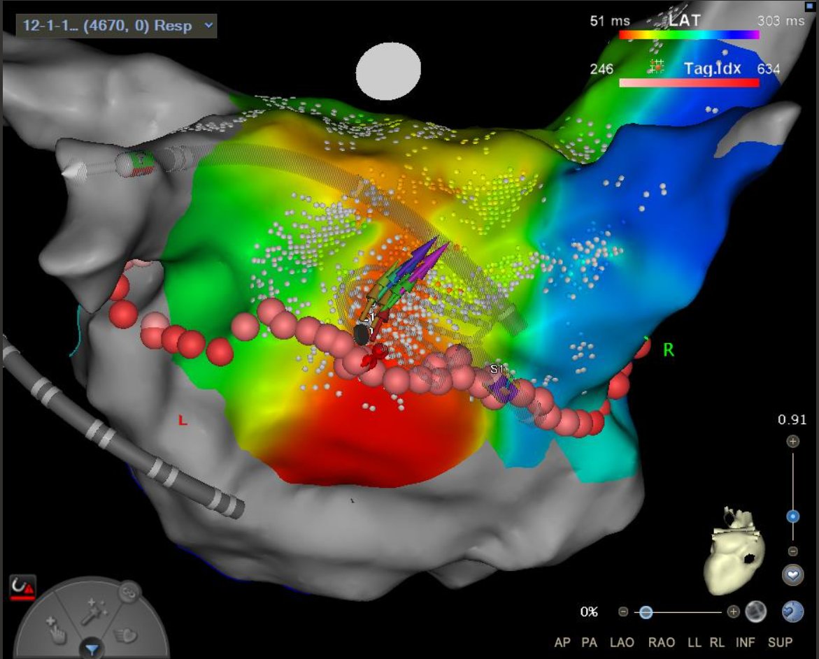 ReddyEPS's tweet photo. Another nice case with OPTRELL!
Re-do Afib with reconnection of 3/4 PVs. Did a SIngle Ring Lesion. Optrell display of vectors with different sizes (speed), direction and color (local timing) were very helpful. @BiosenseWebster @josoriomd @jskoruth @gautamsand @SethHSheldon https://t.co/Wh8Fo1NR8X