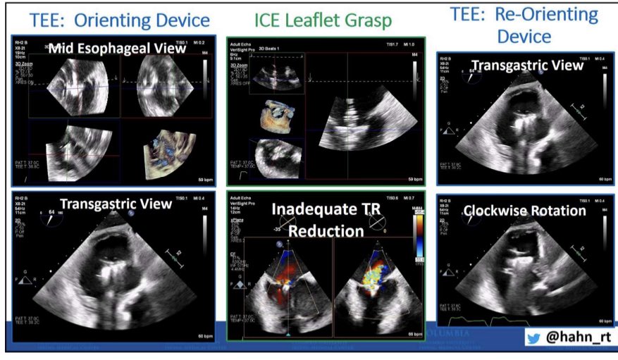 hahn_rt's tweet image. Speaking now at Philips Engagement Hub #TCT2022.  Hear about tricuspid valve imaging!!! @TCTMD