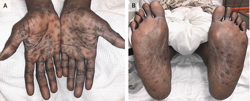 BrownJHM's tweet photo. A 62-year-old man p/w weakness &amp; a diffuse rash. Exam showed maculopapular, hyperpigmented, &amp; scaly eruption on his palms. Hx of unprotected intercourse with multiple partners. No hx of chancres. HIV negative. What is the diagnosis &amp; Rx? #IDtwitter #MedEd  https://t.co/dWeq3fM1Qf https://t.co/vFSzf3kBTx