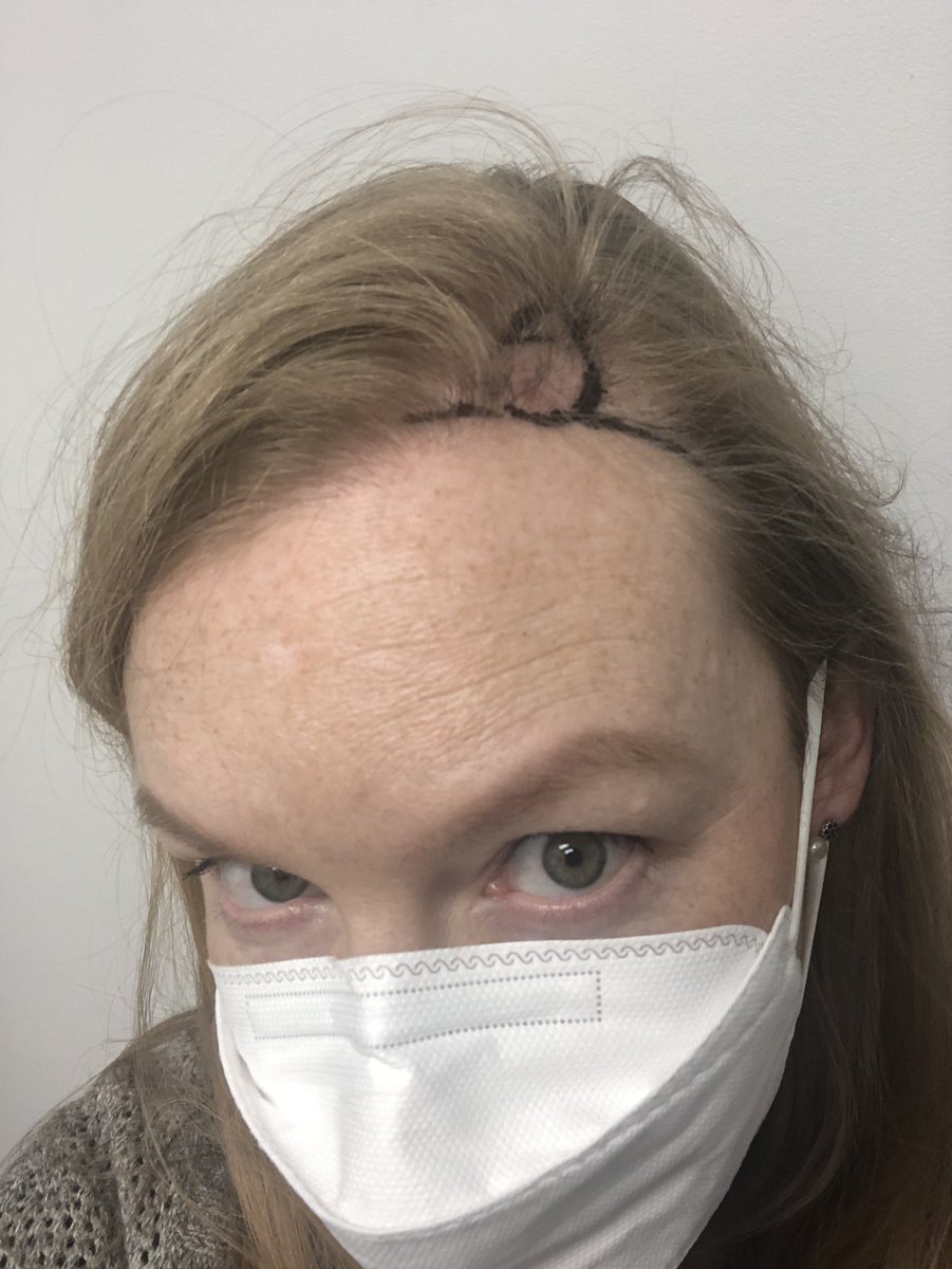 EmilyDenooij's tweet photo. PSA: even if you think you look stupid in a hat, WEAR ONE ANYWAYS! Skin cancer is a bitch. https://t.co/zfoUxMaNwn