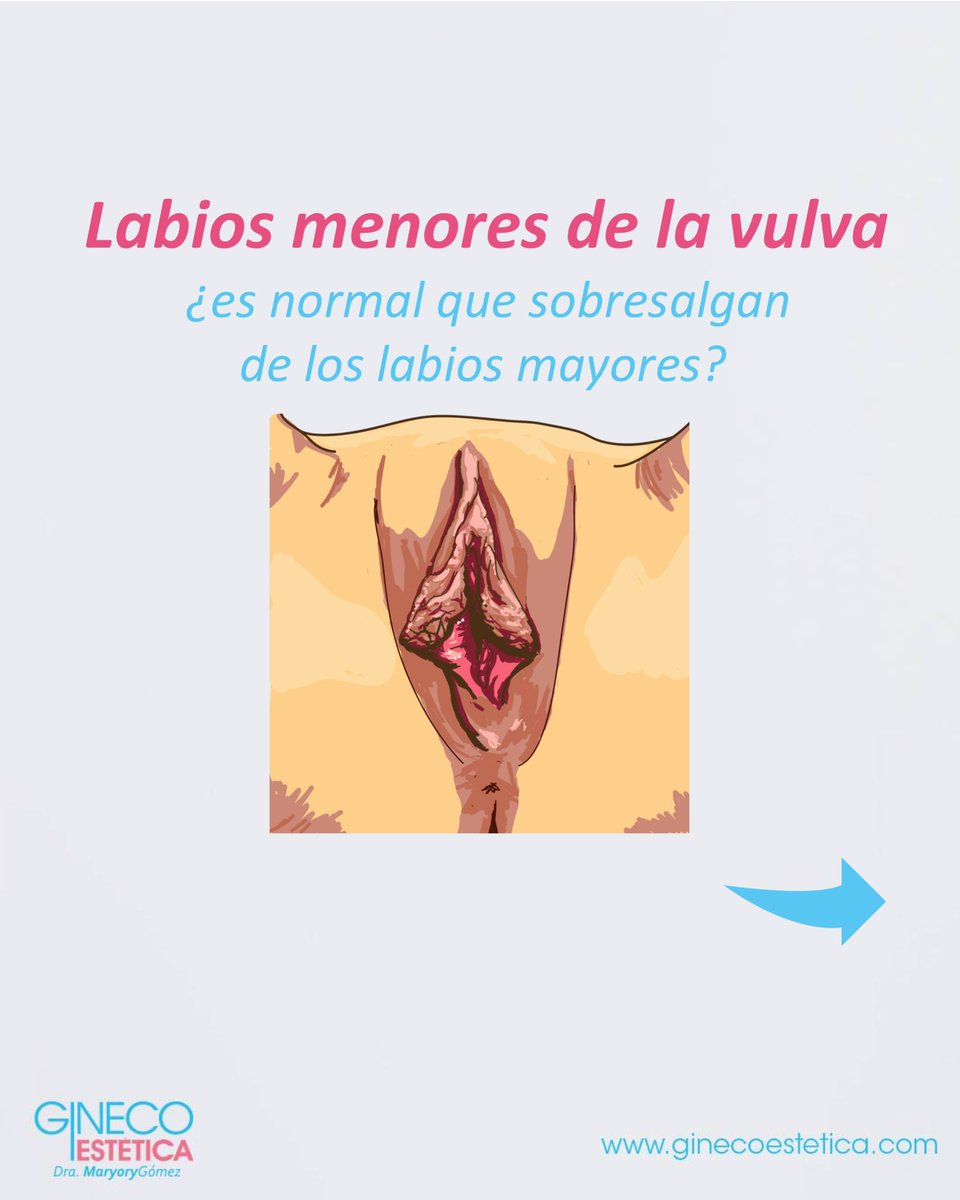 ginecoestetica's tweet photo. ¿Has presentado esta incomodidad o conoces de alguien?.. solo quien lo padece, lo entiende. Pero tú que me estás leyendo, ya sabes que puede existir la solución a tu problema. #ginecoestetica #cirugiaintima https://t.co/z3auHx7vpP
