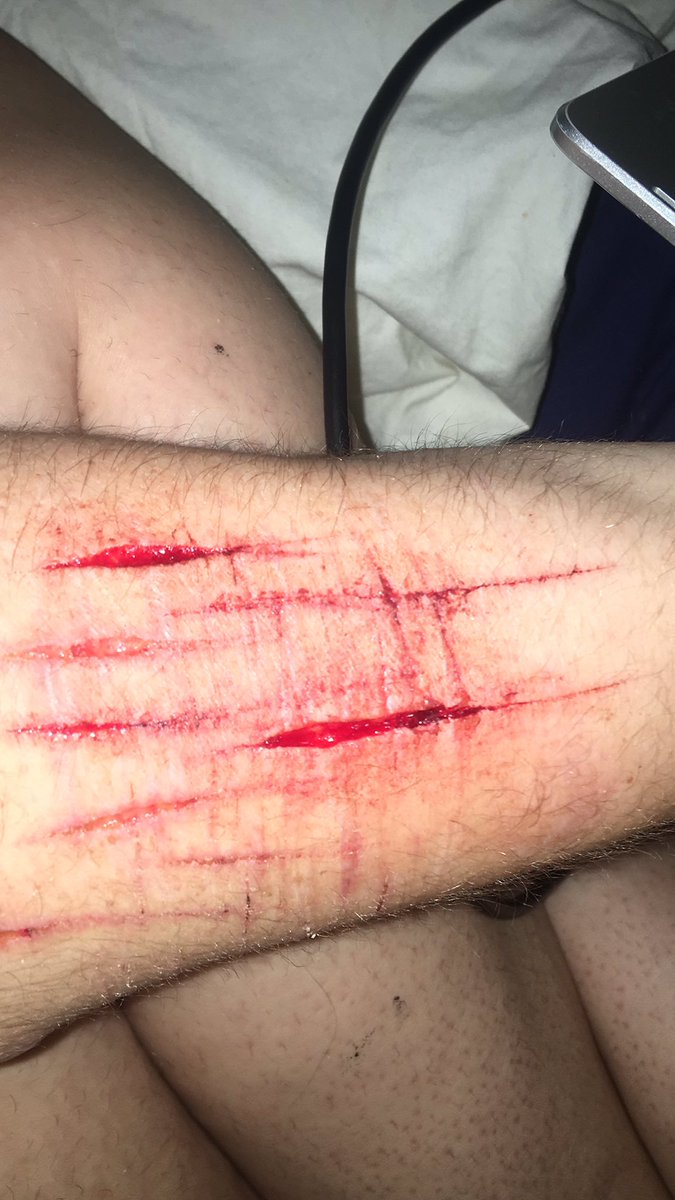 selfharmsisters's tweet photo. here they are after about 20 mins xx 
•
•
•
•
•
#shtwt shtwt #cutting #cuttingarm babybeans styros #styros #babybeans https://t.co/SbGluAhs4w