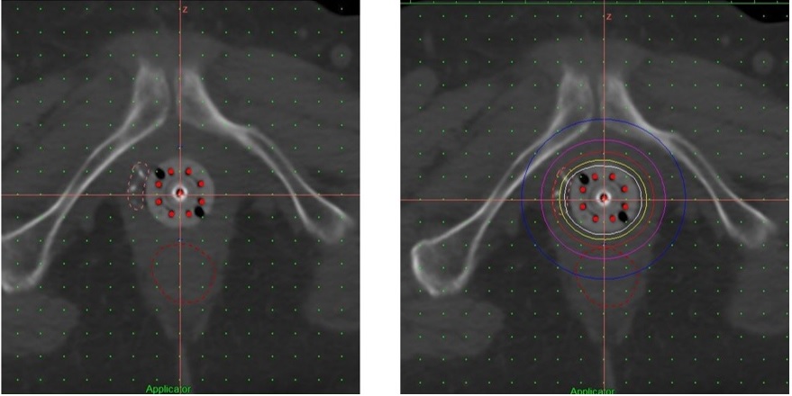VideraSurgical's tweet photo. VeraForm expansion in Gyn oncology! Article/case study highlighting recent cases and potential impact for treatment. @MountSinaiNYC @ProvCalifornia @peacehealth;compelling case study by rad oncs Scott Schneider M.D. and Nico De Wette M.D. #VeraForm
https://t.co/wDhlM6errw https://t.co/duazZ0plxd