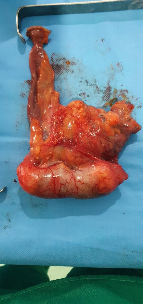 Appendicular tumor