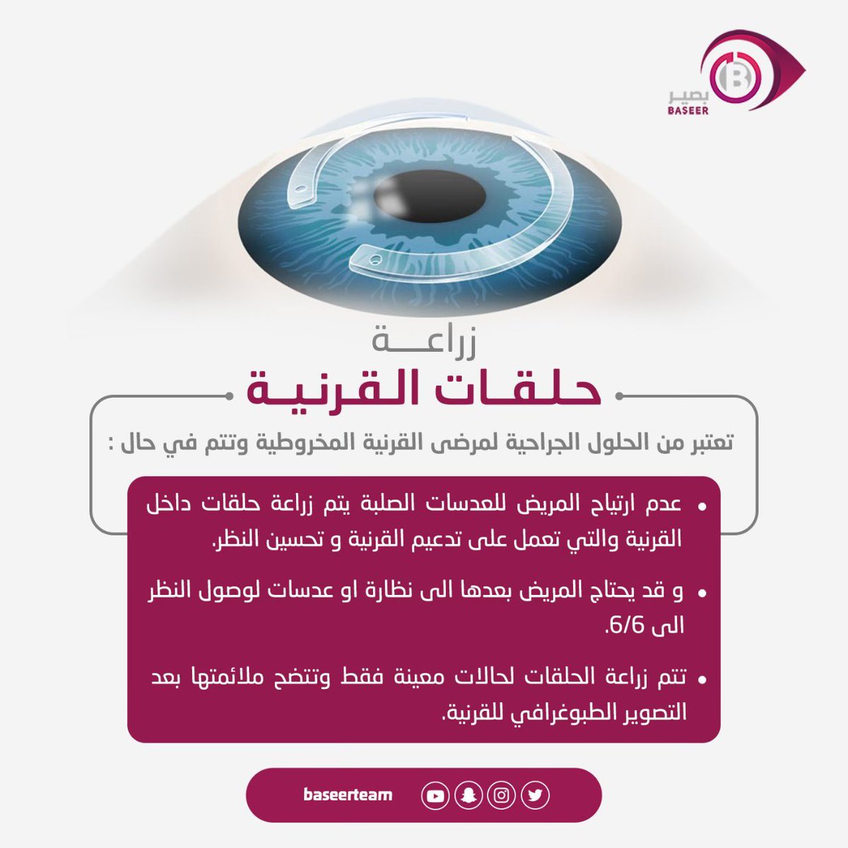 baseerteam's tweet photo. ↙️↙️

#زراعة_الحلقات هي احدى الحلول الجراحية لعلاج القرنية المخروطية وتتم في حالات خاصة و شروط معينة ..! https://t.co/Gn6SKDuQRH