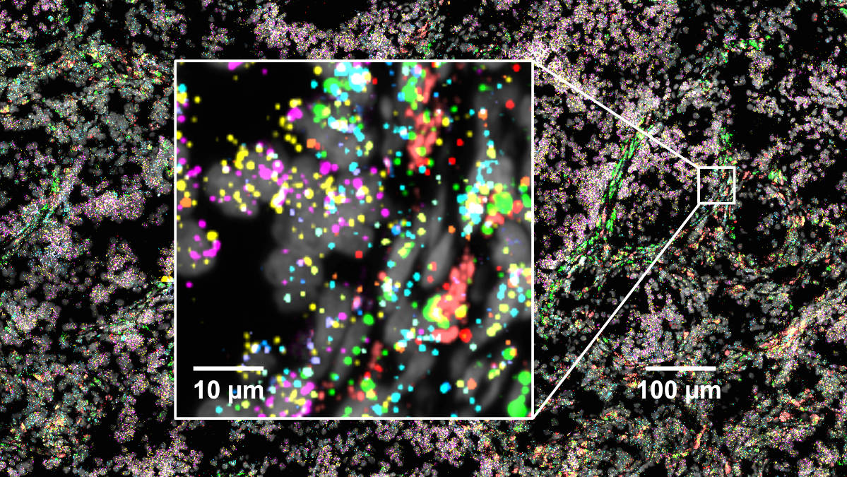 How are proliferating and differentiated tumor cells connected? In an exciting project with @Pajtler_Lab et al. we contributed spatial transcriptomics experiments to map the cell fate trajectory in brain tumor tissue biorxiv.org/content/10.110…