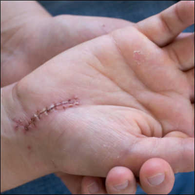 SanihausSchweiz's tweet photo. Narben an der Hand richtig behandeln - darauf sollten Sie achten: https://t.co/Lok6aQujKt
#narbe #scar #hand #behandlung #verbrennung #op #burn https://t.co/jRsdO2H5ja