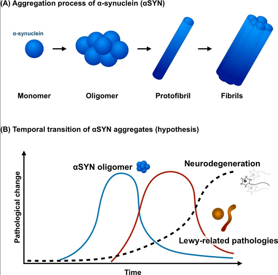 ScienceofPD's tweet photo. Researchers examine the distribution of α-synuclein oligomers in formalin-fixed paraffin-embedded brain samples from patients with #Parkinsons; Distribution of oligomers = more widespread than that of Lewy-related pathology
https://t.co/IlwZbDD01p https://t.co/TDpKh4IXeu