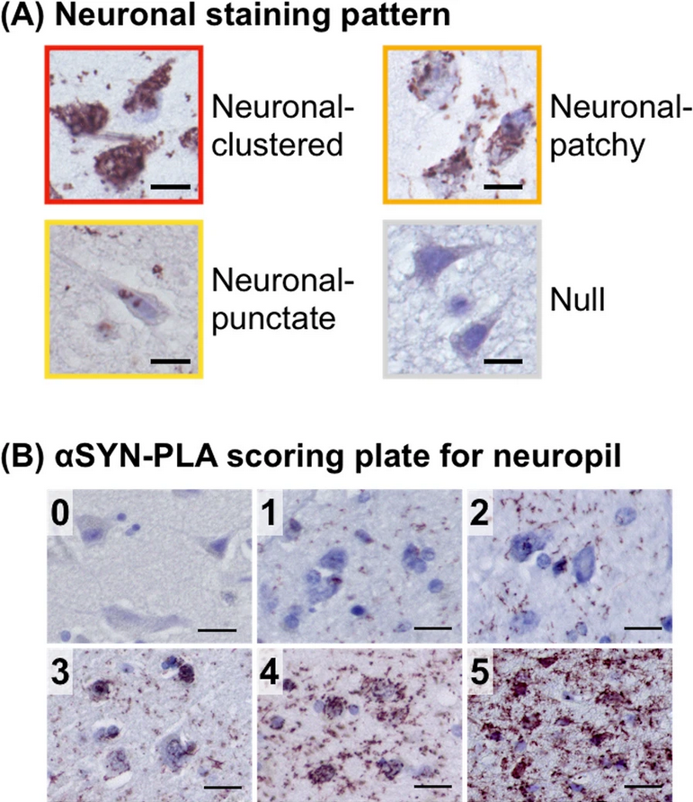 ScienceofPD's tweet photo. Researchers examine the distribution of α-synuclein oligomers in formalin-fixed paraffin-embedded brain samples from patients with #Parkinsons; Distribution of oligomers = more widespread than that of Lewy-related pathology
https://t.co/IlwZbDD01p https://t.co/TDpKh4IXeu