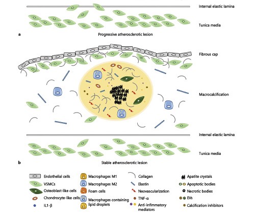 CardioKarger's tweet photo. Inflammation and #Microcalcification: A Never-Ending Vicious Cycle in Atherosclerosis?
β Lynn Kawtharany
π https://t.co/8e2E5rI7vC
#JVascRes #FreeAccess #Atherosclerosis #VSMC #PlaqueInflammation https://t.co/64jeLsZxnl