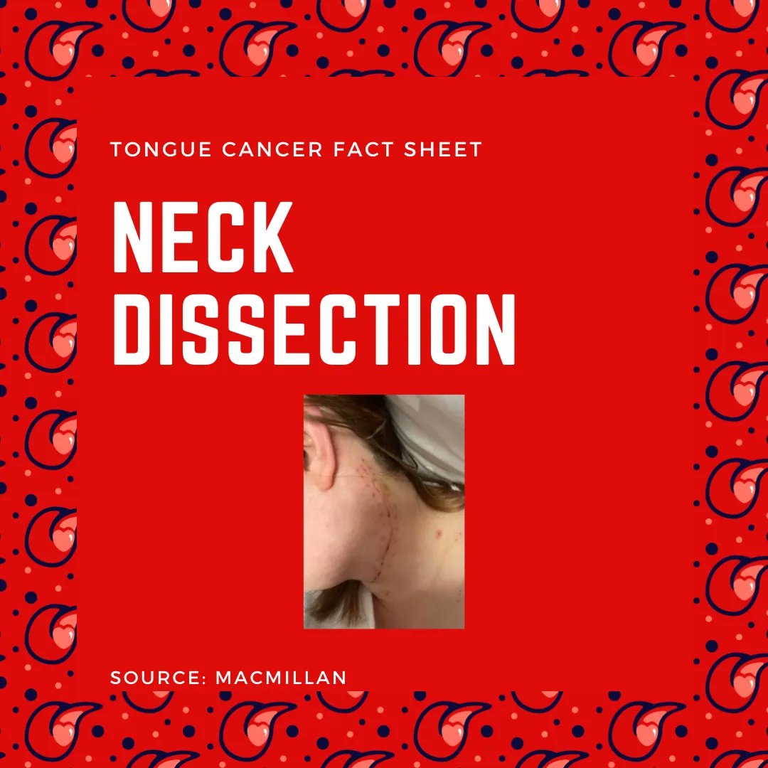 YoungTongues_'s tweet photo. 📝ᴛᴏɴɢᴜᴇ ᴄᴀɴᴄᴇʀ ꜰᴀᴄᴛꜱʜᴇᴇᴛ - Neck Dissection
If you wondered why most of us have a little faint scar running under our neck.
⠀⠀⠀⠀⠀⠀⠀⠀
#TongueCancer #OralCancer #OralCancerAwareness #CancerAwareness #Mouthcancer #OralHealth #NeckDissection https://t.co/11hX4ZVNh6