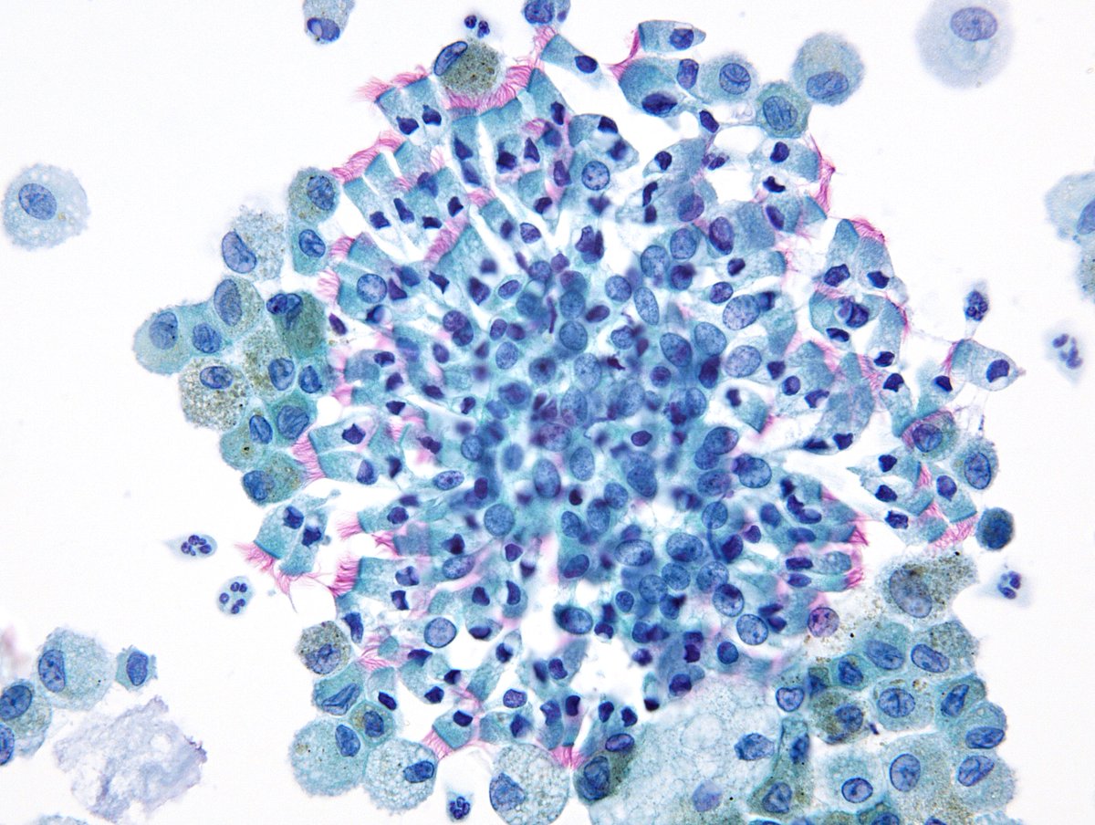 Simply beautiful - Normal CYTOMORPHOLOGY appreciated with Papanicolaou stain - Bronchoalveolar Lavage with ciliated bronchial epithelial cells circumferentially juxtaposed to alveolar macrophages.