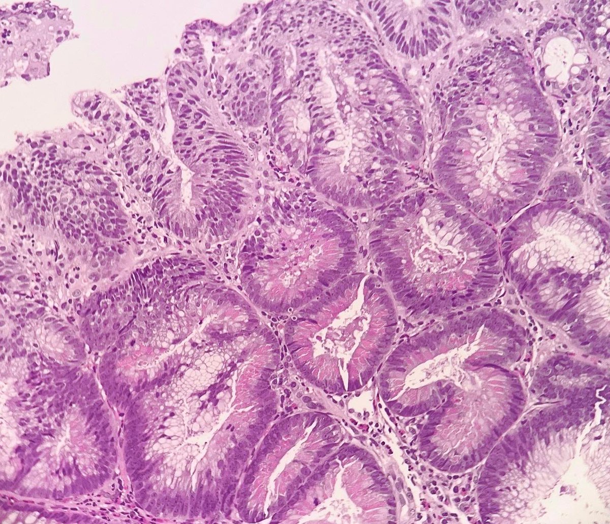 patologia_td's tweet photo. #paneth cell enriched rectal adenoma https://t.co/nm4alJ78MR