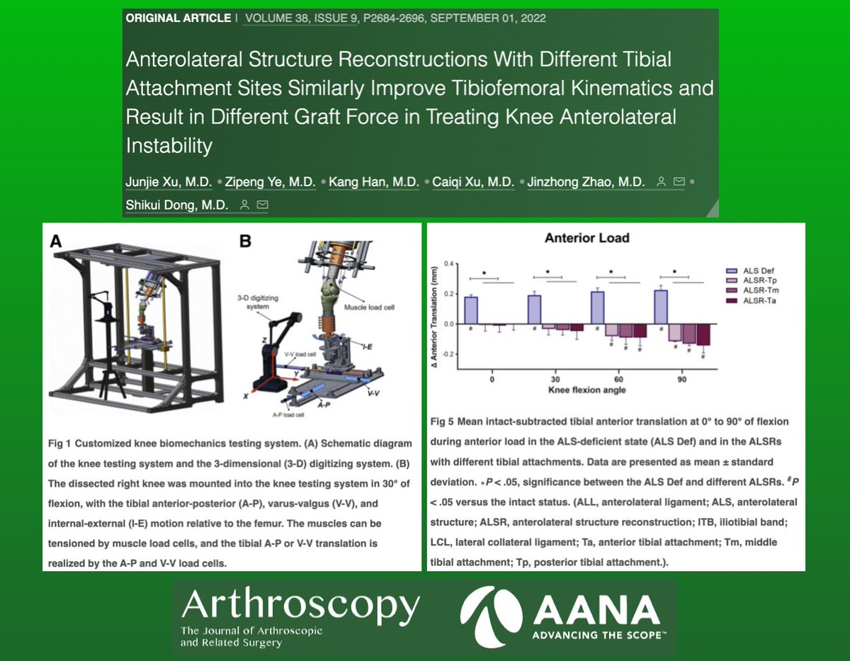 ArthroscopyJ's tweet photo. This new study in Arthroscopy reports kinematics of anterolateral structure reconstructions with varied tibial attachment sites in the treatment of anterolateral knee instability: https://t.co/NcnSntzCUo #knee #ACL #ALL #LEAT #LET #ALSR #biomechanics #kinematics #arthroscopy https://t.co/hbxdGxzP4Z