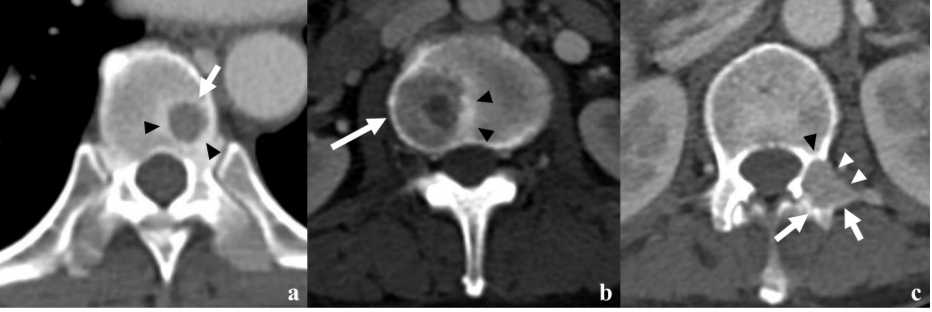 BJR_Radiology's tweet photo. Differentiation of multiple myelomas from osteolytic bone metastases: Diagnostic value of tumor homogeneity on Contrast-Enhanced CT
https://t.co/NAomLABGP7
#CT #Radiology https://t.co/zwgd2Mh2g6