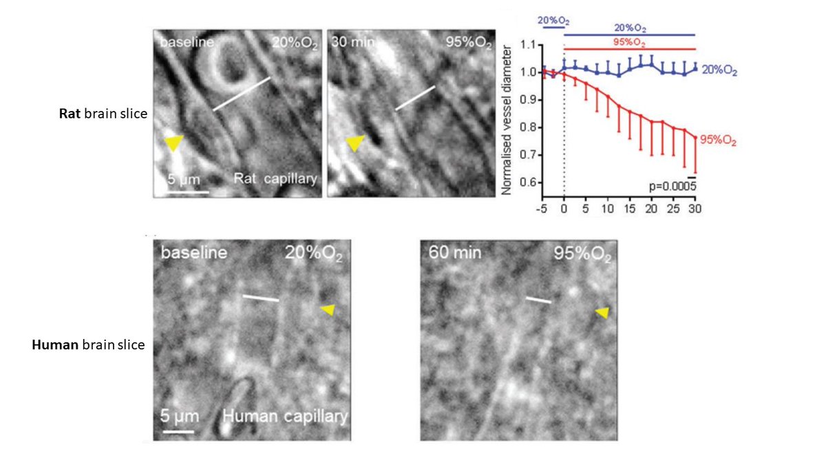 Christian Staehr (@chrstaehr) on Twitter photo Hyperoxia (95% O2) evokes #pericyte-mediated
#capillary constriction compared to normoxia. Human #brain slice experiments take this paper from David Attwell's lab to the next level😅:
journals.sagepub.com/doi/full/10.11…
#vascularbiology <a href="/th_pfeiffer/">Thomas Pfeiffer</a> Hyperoxia (95% O2) evokes #pericyte-mediated
#capillary constriction compared to normoxia. Human #brain slice experiments take this paper from David Attwell's lab to the next level😅:
journals.sagepub.com/doi/full/10.11…
#vascularbiology <a href="/th_pfeiffer/">Thomas Pfeiffer</a>