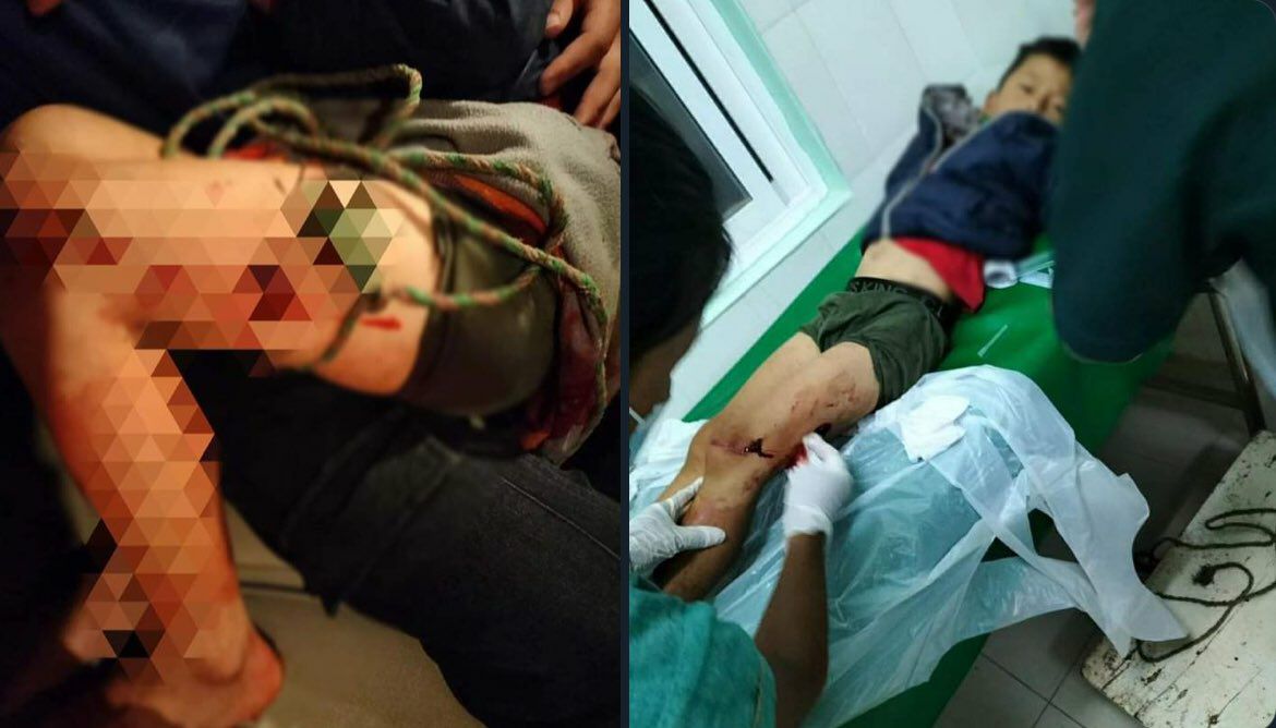 cassiakhin's tweet photo. Tw // wound  2 children were wounded as the artillery shells fired by military junta troops fell &amp; exploded in MawHit village,Shan state.   #2022Sept7Coup #UN_ProveYourExistence4Justice #WhatsHappeningInMyanmar https://t.co/KAvjdREcEb