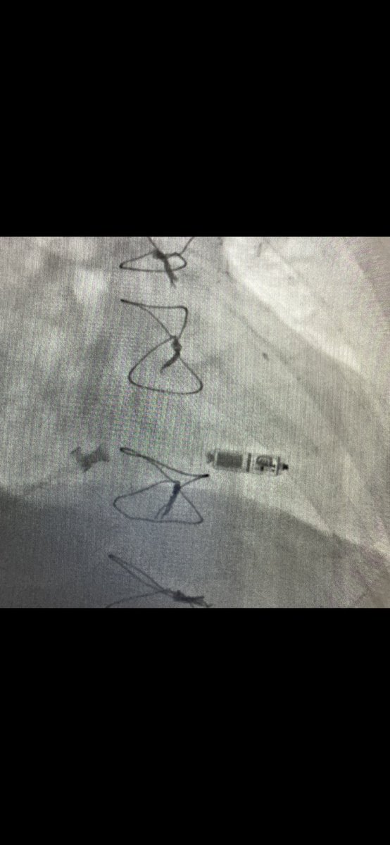 rfablation's tweet photo. #Epeeps nice #Hispacing and EGM obtained by Micra VR @messapus @Hisdoc1 @DrRoderickTung https://t.co/Fl96CeMAy2