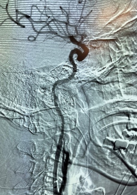 ImpCare_Stroke's tweet photo. Another #ClotOfTheWeek from Dr. Praveen Venkatachalam at Bon Secours Mercy Health. Congratulations on a carotid + tandem occlusion #thrombectomy using #Zoom71 and #Zoom35 – thank you for sharing! #ZoomPOD
Important Safety Information: https://t.co/WILvGOFc8J https://t.co/AfJDhOALKl