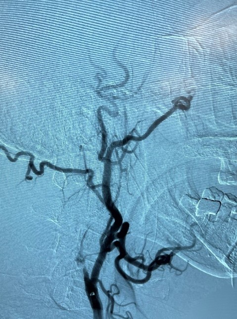 ImpCare_Stroke's tweet photo. Another #ClotOfTheWeek from Dr. Praveen Venkatachalam at Bon Secours Mercy Health. Congratulations on a carotid + tandem occlusion #thrombectomy using #Zoom71 and #Zoom35 – thank you for sharing! #ZoomPOD
Important Safety Information: https://t.co/WILvGOFc8J https://t.co/AfJDhOALKl