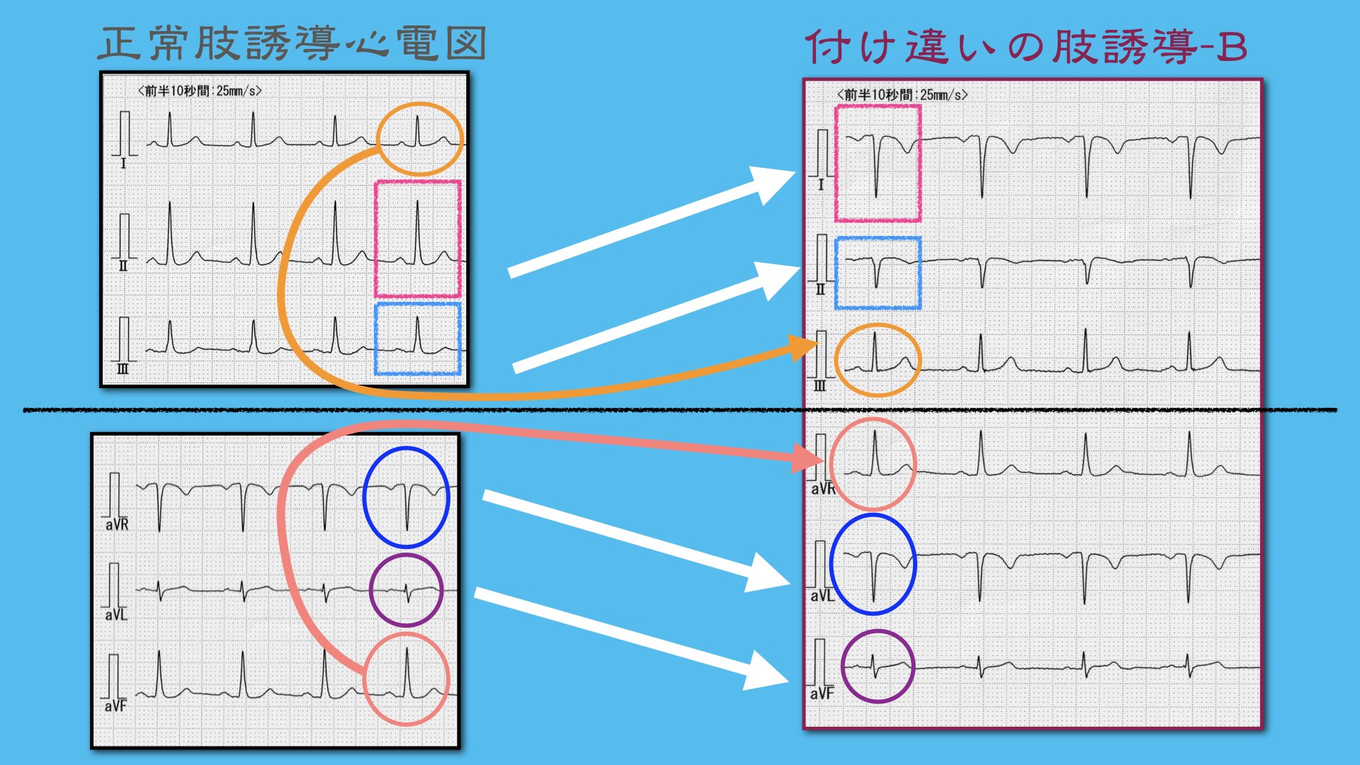 N. Tsukishima EP大学心電図検定学部試験対策科担任 on X N. Tsukishima EP大学心電図検定学部試験対策科担任 on X