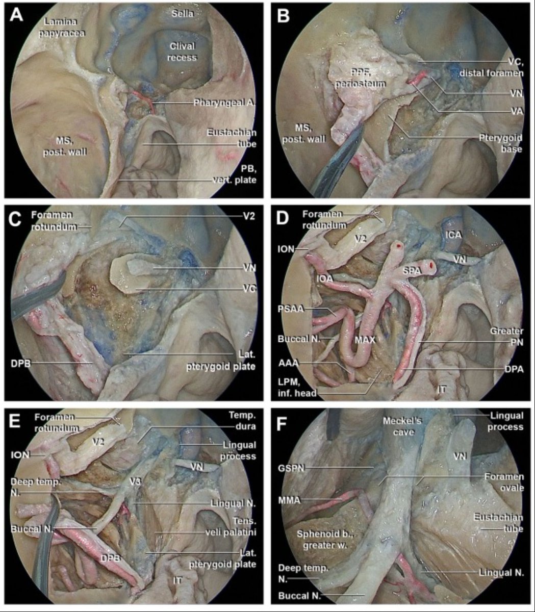 Mayo Clinic ENT (@mayoclinicent) on Twitter photo Is a combined EETPA and sublabial transmaxillary approach a safe and effective option for extracranial trigeminal schwannoma excision?
Click to read more: bit.ly/3RlU8ze
#MayoENTresearch #ENT #MayoClinicENT #Rhinology <a href="/dr_pinheiro/">Carlos Pinheiro-Neto, MD PhD</a> <a href="/PerisCelda/">Maria Peris-Celda, MD PhD</a> #GarretChoby Is a combined EETPA and sublabial transmaxillary approach a safe and effective option for extracranial trigeminal schwannoma excision?
Click to read more: bit.ly/3RlU8ze
#MayoENTresearch #ENT #MayoClinicENT #Rhinology <a href="/dr_pinheiro/">Carlos Pinheiro-Neto, MD PhD</a> <a href="/PerisCelda/">Maria Peris-Celda, MD PhD</a> #GarretChoby