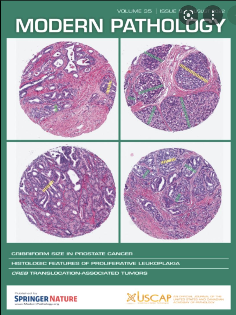 Do you know Intraductal tubulopapillary neoplasm (ITPN) of the pancreas 😱 ?! Now i do ... 😎 🦀 Concomitant cancer (75%) molecularly associated to intraductal component 🧬 Can arise in BRCA-germline / Peutz–Jeghers 👺 TP53 marker of bad prognosis nature.com/articles/s4137…