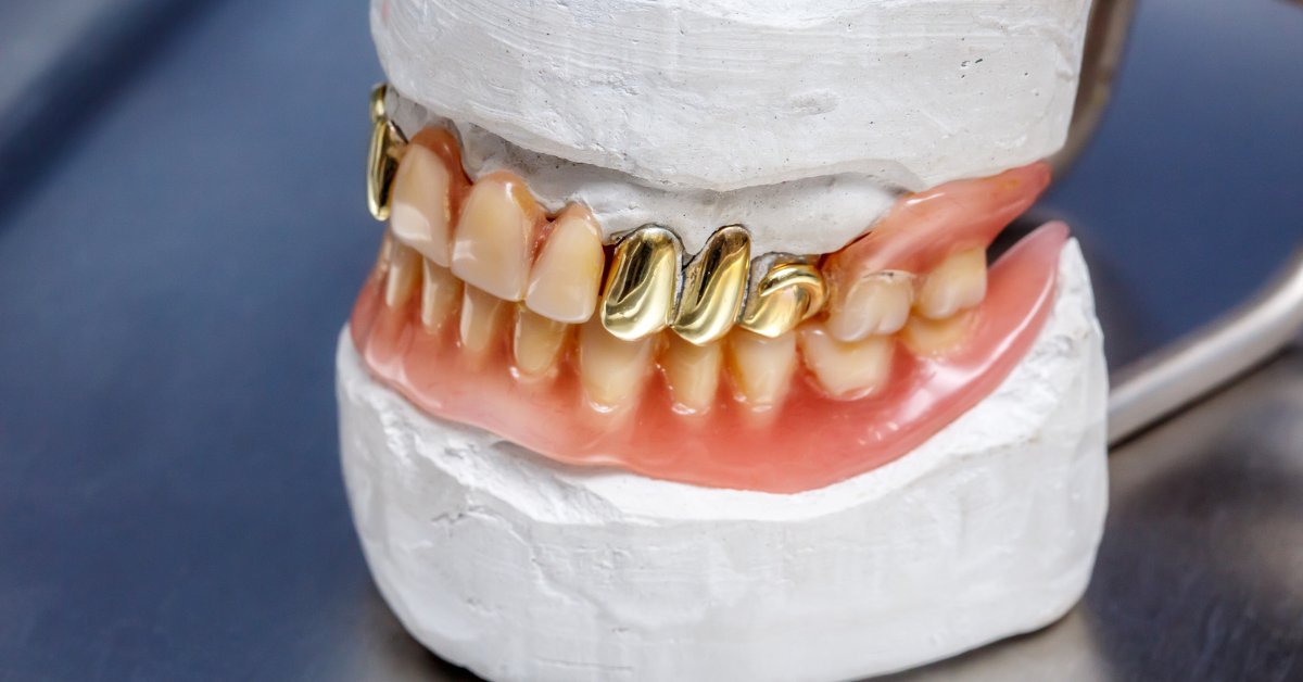 ManhattanGold's tweet image. Scrap gold and other precious metals accumulate quickly in dental offices. Find out how your practice can monopolize the excess materials. bit.ly/3Kpg8qO