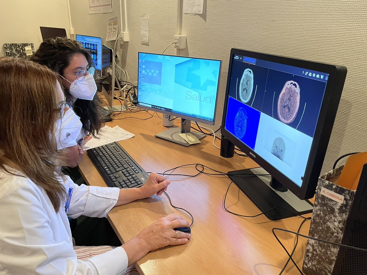 MaraNievesCabr1's tweet photo. Hoy hemos adquirido el primer estudio PET- tau en nuestro servicio @NuclearMadrid😊 Comenzamos un nuevo proyecto de investigación con @iNeuroClinico @IdISSC como un paso más en el diagnóstico y terapia de la enfermedad de Alzheimer #somosclinico @MatiasGuiu @P_Bascu @pedronespral https://t.co/BRadKZ2Wc1