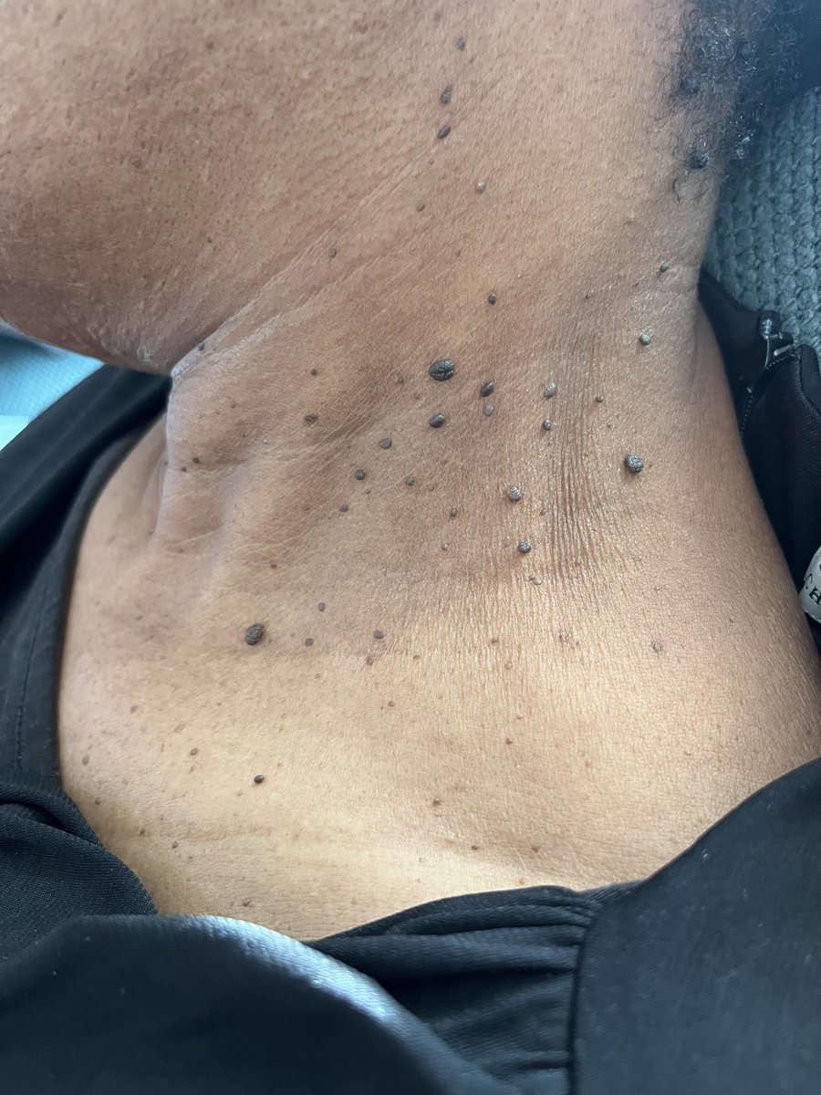 flick_that's tweet photo. Skin Tag Removal!
💉Pain; 0% (numbing cream used)
⏱Time; 30min + 
💵Cost; R600 per 30min (standard time) 
📍JHB Housecall; All in a comfort of your home! ( tranport charged as per location) 
DM! 

#AndileMpisane #shoprite #podcastandchillwithmacg  natasha #GirlsTalkZA  #iPhone14 https://t.co/aGjMooG8Il