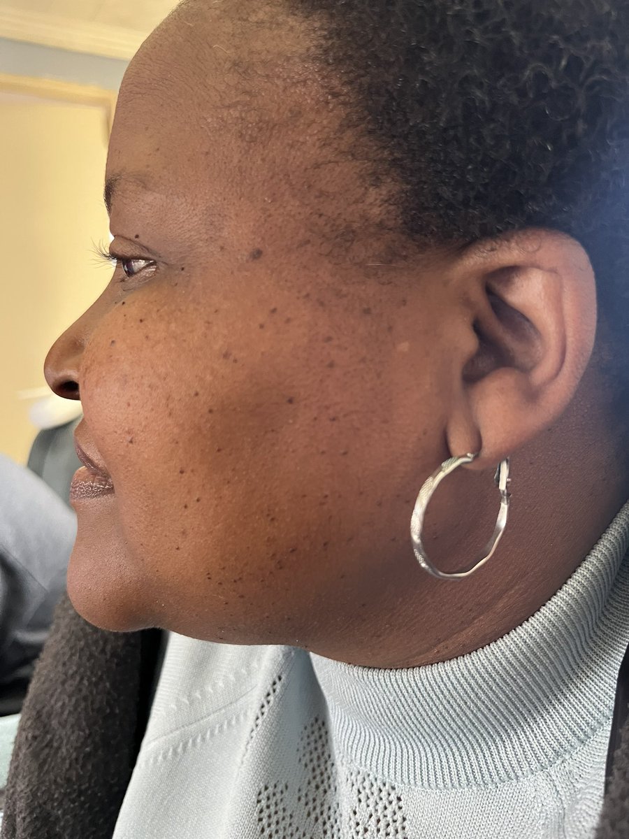 flick_that's tweet photo. Skin Tag Removal!
💉Pain; 0% (numbing cream used)
⏱Time; 30min + 
💵Cost; R600 per 30min (standard time) 
📍JHB Housecall; All in a comfort of your home! ( tranport charged as per location) 
DM! 

#AndileMpisane #shoprite #podcastandchillwithmacg  natasha #GirlsTalkZA  #iPhone14 https://t.co/aGjMooG8Il