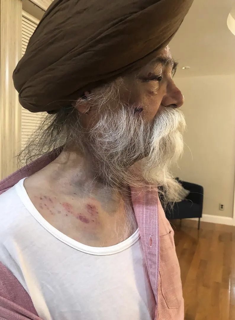 We find ourselves here yet again...

This is 82 year old Onkar Singh, who was brutally assaulted and attacked while he was taking a walk after dinner. Although he is in Chardi Kala, while talking to him I could hear how shaken up he really is following this situation.

1/2