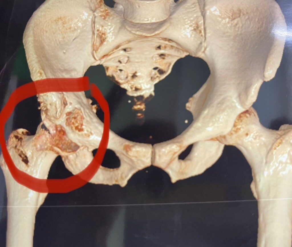 DrNaveenThiyagu's tweet photo. Man in 4th decade with eaten up pelvis bone on Right side
•
•
•
•
•
#alphaorthoclinic #Orthopaedic_Surgeon #Orthodoctor #pondicherry #acl_surgery #trauma_care #Knee_replacement #Joint_replacement_surgeon #joint_pain #alpha_hospital #alpha_cli… https://t.co/GJKAAOXKCY https://t.co/K9usVj9yI8
