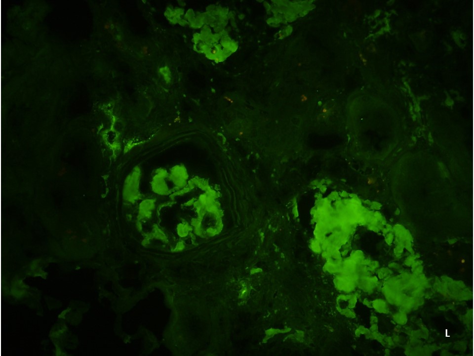 AL amyloidosis in a man in 70s with IgG lambda monoclonal gammopathy. Amyloid protein seen in glomeruli (*), arteries and interstitium (*). #renalpath