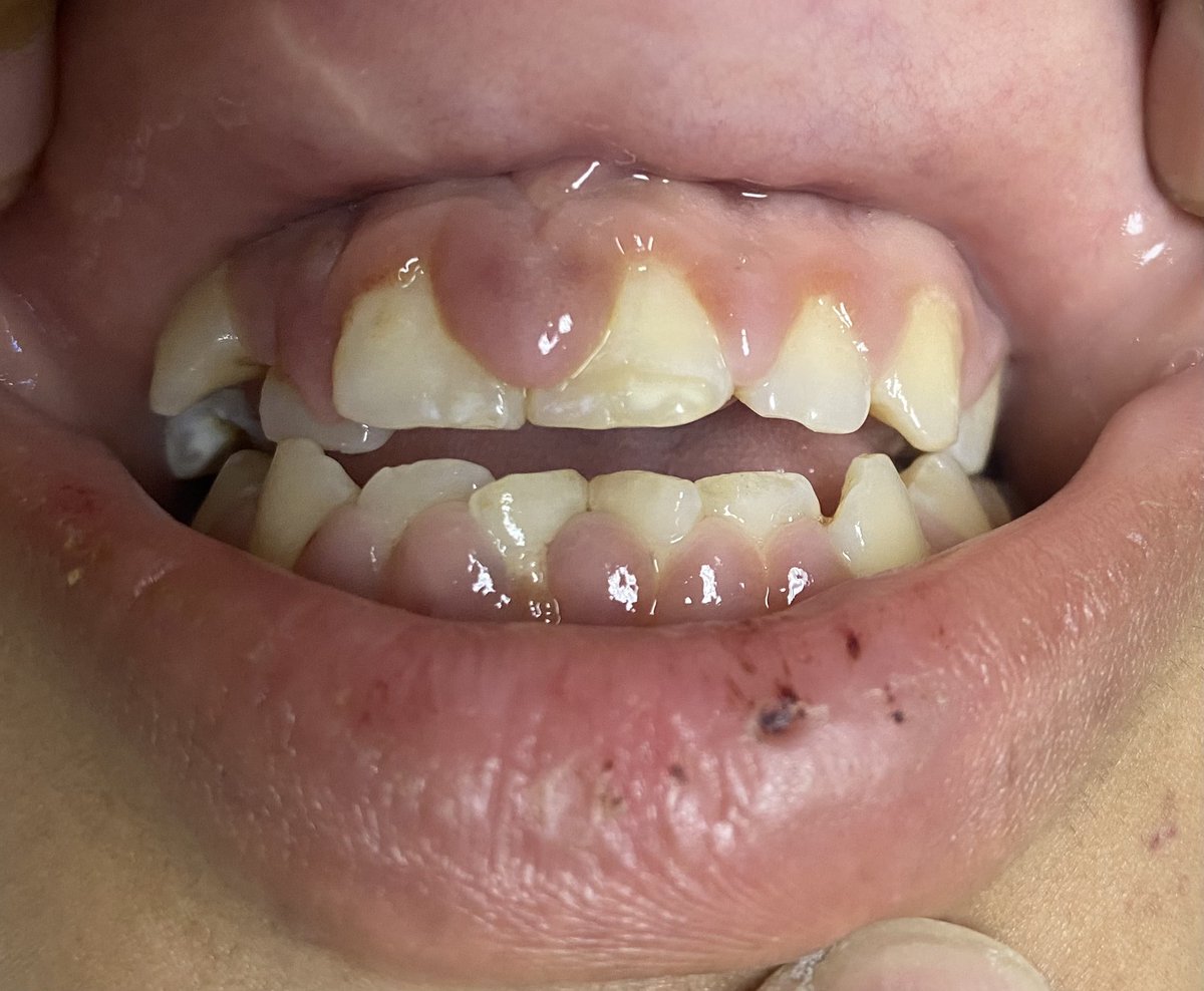 mdqmke's tweet photo. M18 años, dolor faríngeo, fiebre, cansancio. Hipertrofia de amigdalas, manejado con antibióticos sin respuesta. (1/6) https://t.co/s2juNrnSoZ