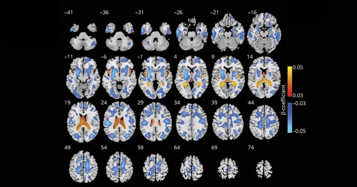 Neurology Journal on Twitter "This study by Wang et al. investigated
