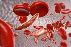 sos_sicklecell's tweet photo. #SickleCellAwarenessMonth
#More2Know
For SCD patients with #diabetes, an A1C test is inaccurate (the hemoglobin isn’t around long enough). Fasting glucose must assess diabetes status. #SickleCell https://t.co/2xqf5QxwLp