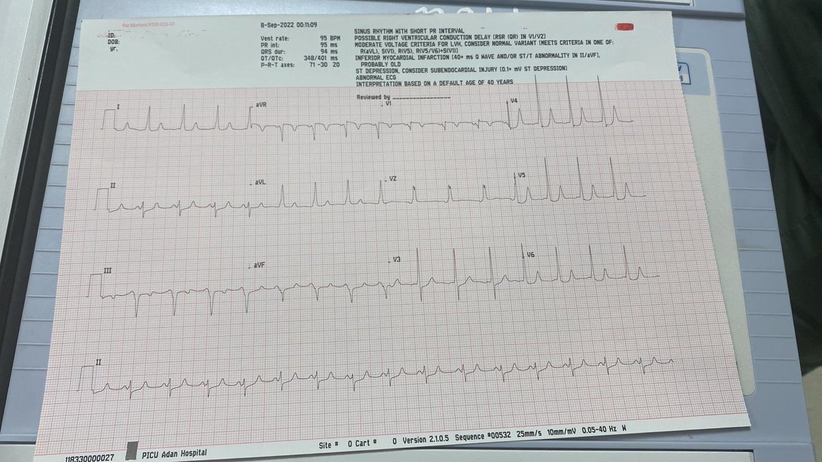 Mohammad Ebrahim (@mo_pedsep) on Twitter photo Preexcited afib in 8 years old last night. Where is the AP? <a href="/Hapa_EP/">Kevin Brady</a> <a href="/Arritmias_HRC/">Arritmias H. Ramón y Cajal, Madrid.</a> <a href="/SergioPinski/">Sergio Pinski</a> <a href="/ALFIEEP1/">ALBERTO ALFIE</a> @ShaunMohan4 <a href="/SchakrabartiEP/">Shanta Chakrabarti</a> <a href="/jeffrey_vinocur/">Jeffrey M Vinocur</a> <a href="/narrowQRS/">JMC</a> <a href="/javadm20/">javad mikaeili</a> <a href="/PACESep/">PACES Pediatric and Congenital EP Society</a> Preexcited afib in 8 years old last night. Where is the AP? <a href="/Hapa_EP/">Kevin Brady</a> <a href="/Arritmias_HRC/">Arritmias H. Ramón y Cajal, Madrid.</a> <a href="/SergioPinski/">Sergio Pinski</a> <a href="/ALFIEEP1/">ALBERTO ALFIE</a> @ShaunMohan4 <a href="/SchakrabartiEP/">Shanta Chakrabarti</a> <a href="/jeffrey_vinocur/">Jeffrey M Vinocur</a> <a href="/narrowQRS/">JMC</a> <a href="/javadm20/">javad mikaeili</a> <a href="/PACESep/">PACES Pediatric and Congenital EP Society</a>