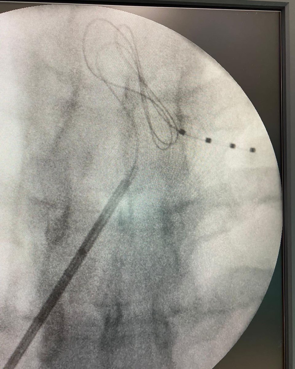 De vuelta a la lucha contra el dolor. Electrodo de ganglio para dolor de pared abdominal una muy buena alternativa al uso de opioides.