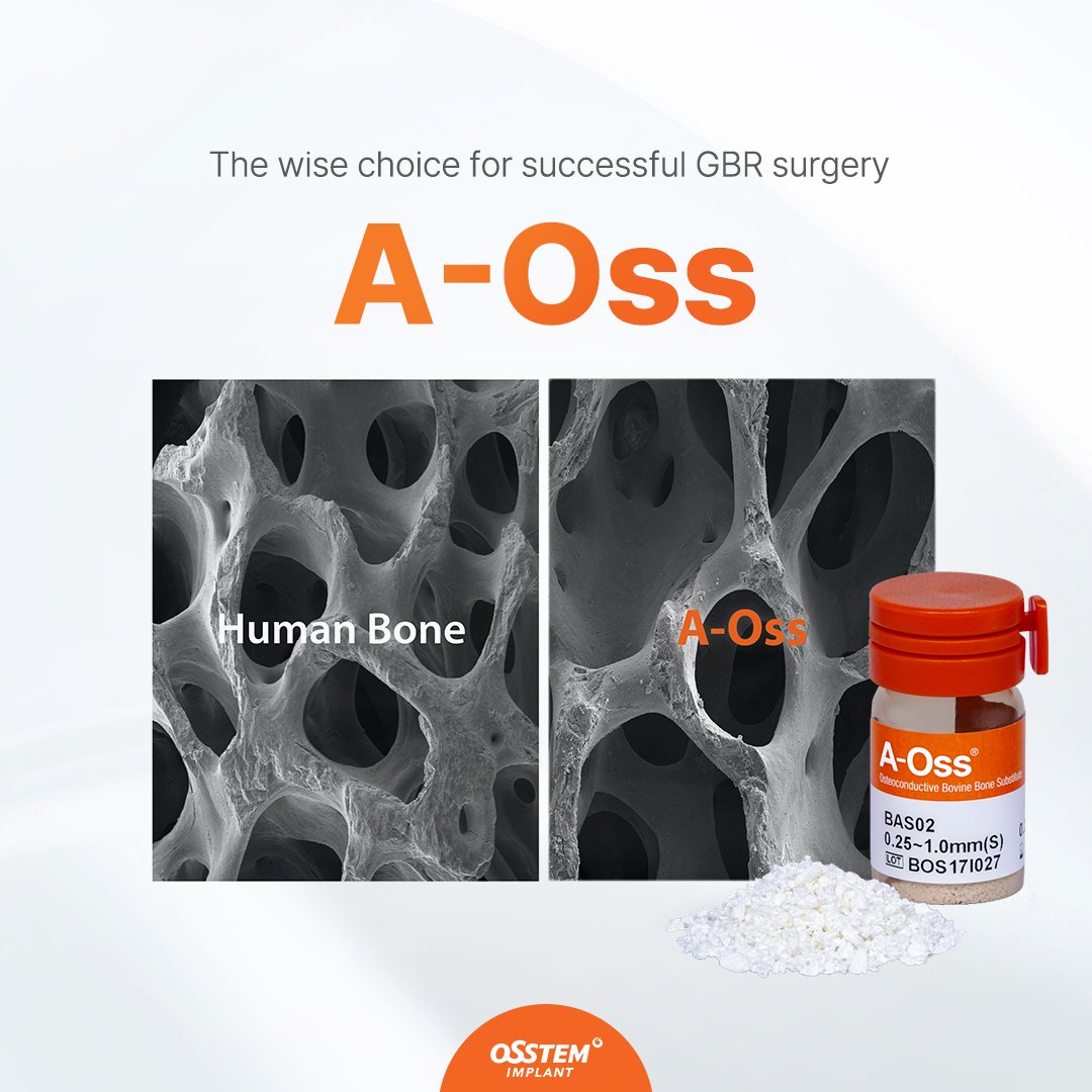 Osstem Implant 
"A-Oss has a good capability to regenerate new bone thanks to its pore and surface structure. Also, by releasing two more types, Osstem Implant improved user convenience." #OSSTEM #OsstemImplant #A_Oss #Xenograft #high #quality #xeno #human #bone #GBR #implant