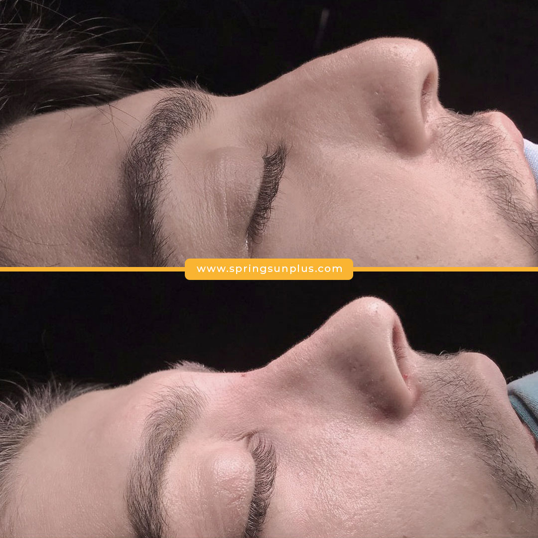 springsunplus's tweet photo. Rhinoplasty in Turkey#rhinoplasty #plasticsurgery #rhinoplastysurgeon #nasenkorrektur #rhinoplastie #rinoplastia #rinoplastika #plasticsurgeryturkey https://t.co/GZjRXQljOZ