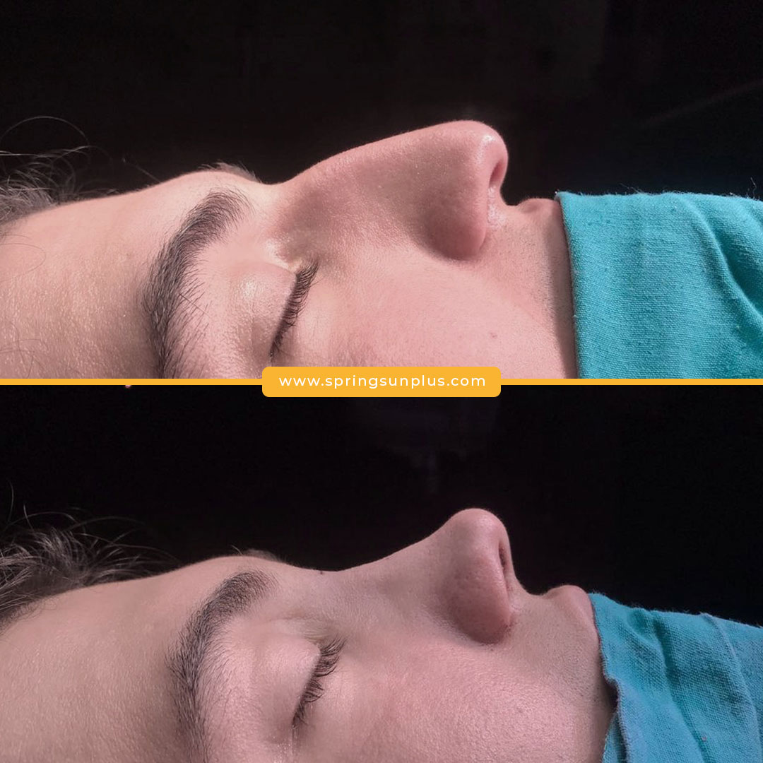 springsunplus's tweet photo. Rhinoplasty in Turkey#rhinoplasty #plasticsurgery #rhinoplastysurgeon #nasenkorrektur #rhinoplastie #rinoplastia #rinoplastika #plasticsurgeryturkey https://t.co/uUF4Rz9L30