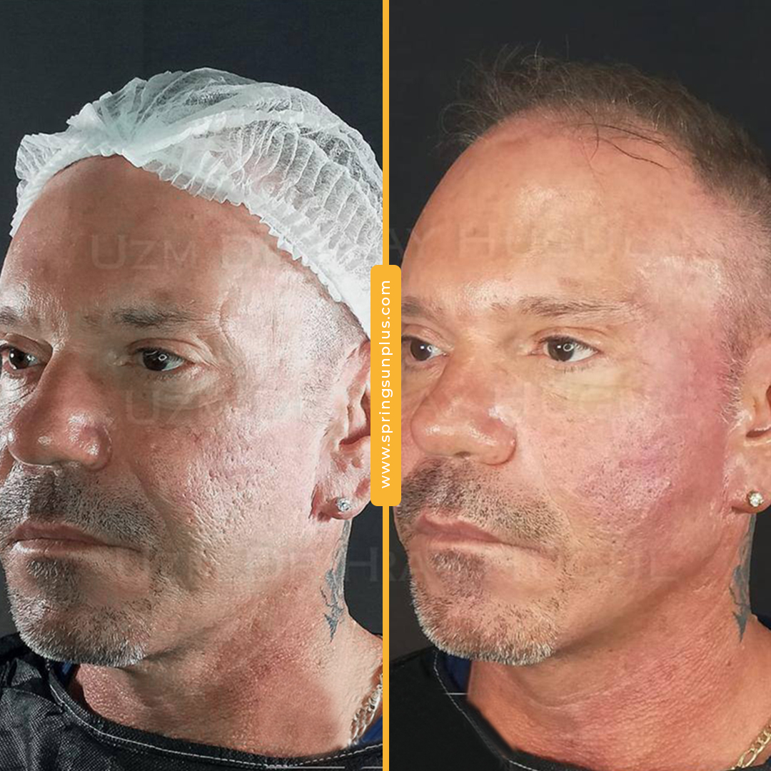 springsunplus's tweet photo. Nonsurgical facelift with threads👍
#facelift #threadandlift #nonsurgical #springsunplus #turkey #healthtourism https://t.co/KiIiGNtIa5