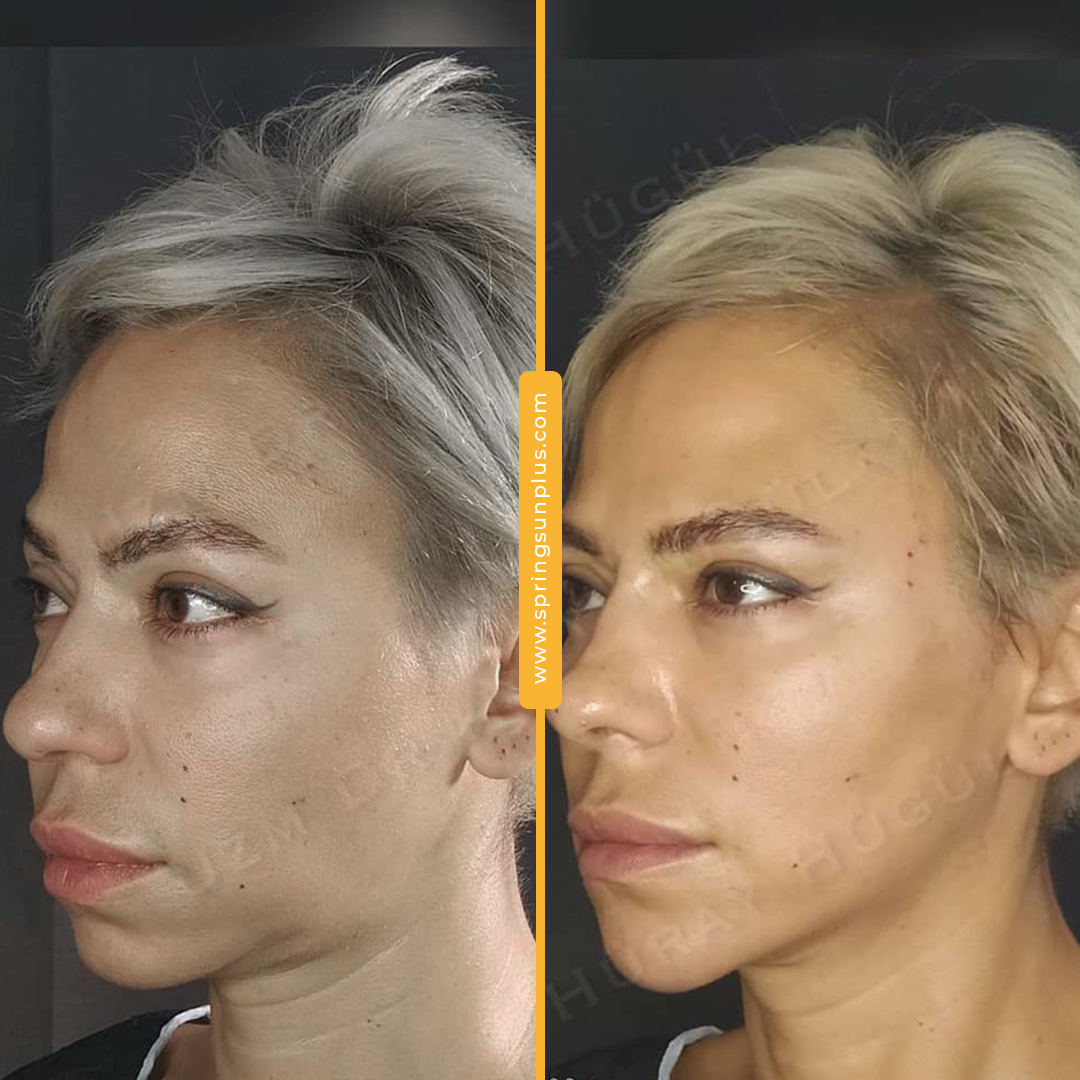 springsunplus's tweet photo. Nonsurgical facelift with threads👍
#facelift #threadandlift #nonsurgical #springsunplus #turkey #healthtourism https://t.co/1Bg1U5fWQH