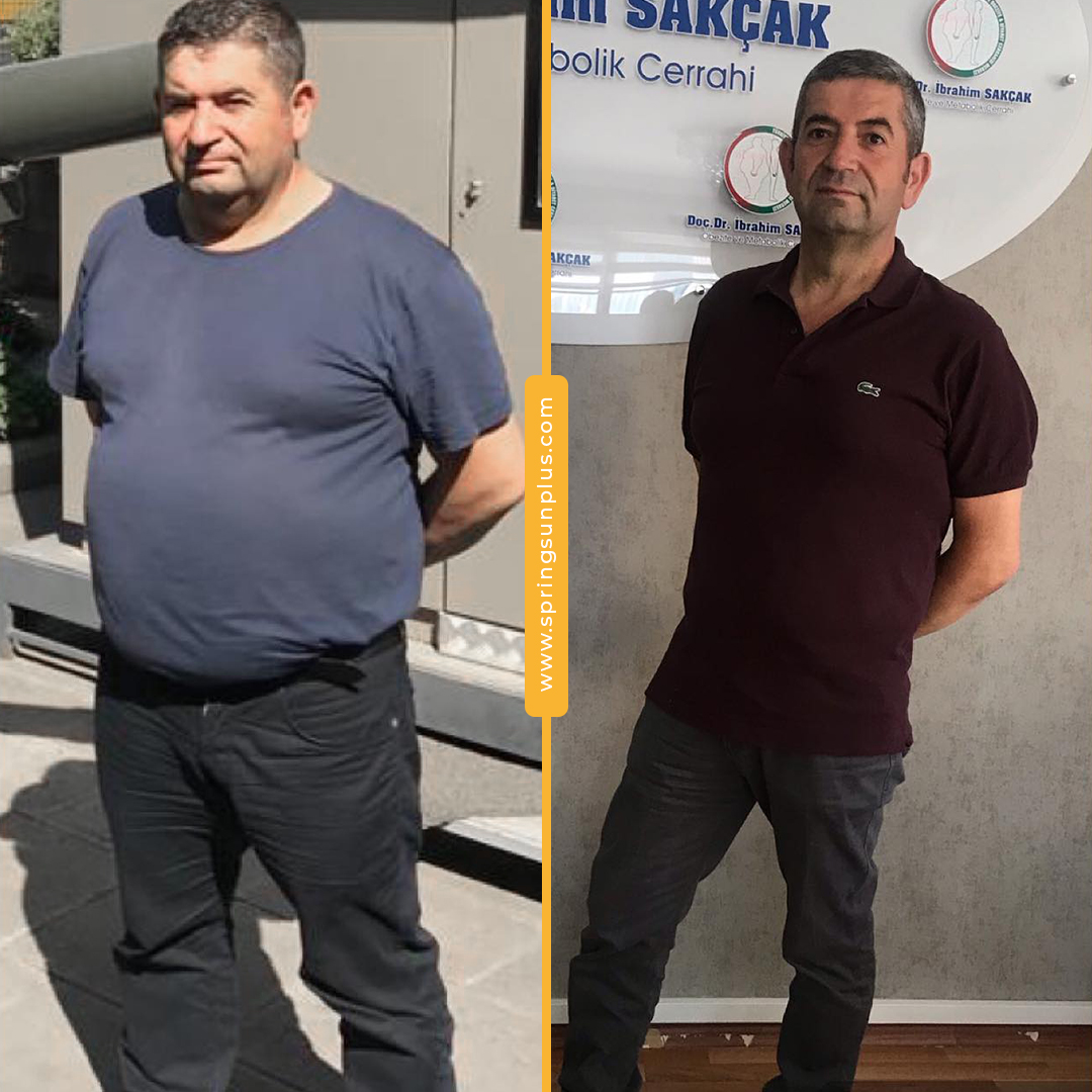 springsunplus's tweet photo. Bariatric Surgery in Turkey
#bariatricsurgeryturkey #gastricsleeve #obesitysurgery #bariatrischechirurgie #chirurgiebariatrique #cirugiabariatrica #springsunplus #turkey #healthtourism https://t.co/NwNrYc7Y0T