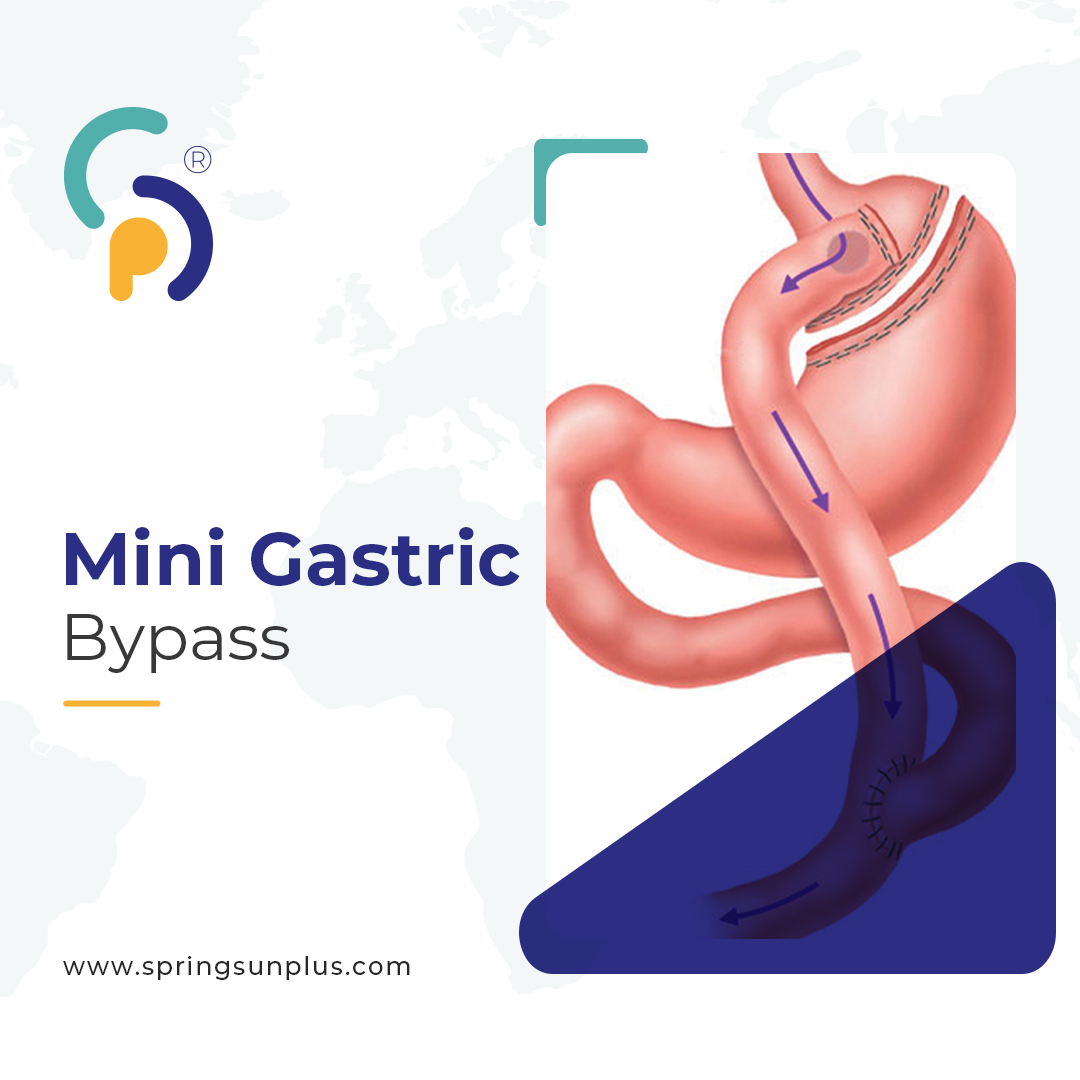 springsunplus's tweet photo. Bariatric Surgery in Turkey
📞 +44 758 402 4458
📞+90 533 553 37 06
🌐 https://t.co/5RiXoAhWO8
#bariatricsurgeryturkey #gastricsleeve #obesitysurgery #bariatrischechirurgie #chirurgiebariatrique #cirugiabariatrica #springsunplus #turkey #healthtourism https://t.co/sUfVggIVvn