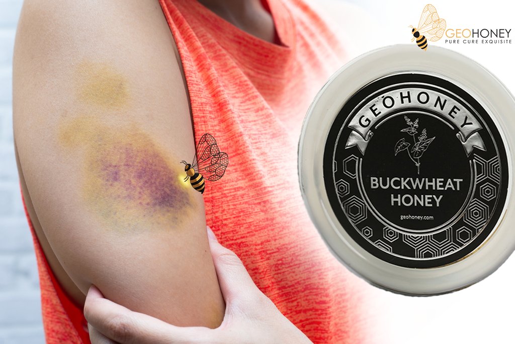 Raw Honey–A Natural Home Remedy For Blood Bruises

We often get blood bruises on our bodies due to some kind of injury. Read More https://t.co/CQK9HhUF0O

#geohoney #organichoney #rawhoney #honey #organichoney #homeremedy #remedy #Injury #healthy #buckwheathoney https://t.co/fQhnBEVFHG