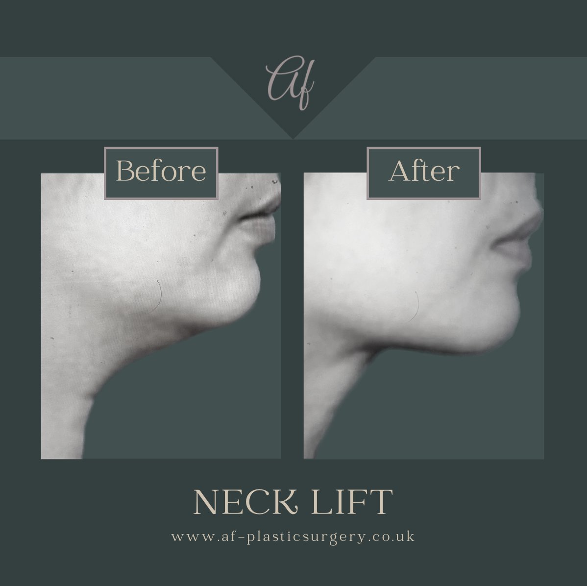afplasticsurgry's tweet photo. To find out more or to book a consultation visit https://t.co/YAfHEHBZA5 or call 0333 090 7761. 

#manchestercosmeticsurgery #cosmeticsurgeon #celebritycosmeticsurgeon #beautytips #surgerytips #natural #result #results #surgeryresults #necklift https://t.co/YWpzBf4pQ5